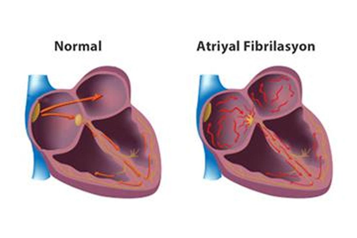 Atriyal Fibrilasyon — bilgilendirme görseli