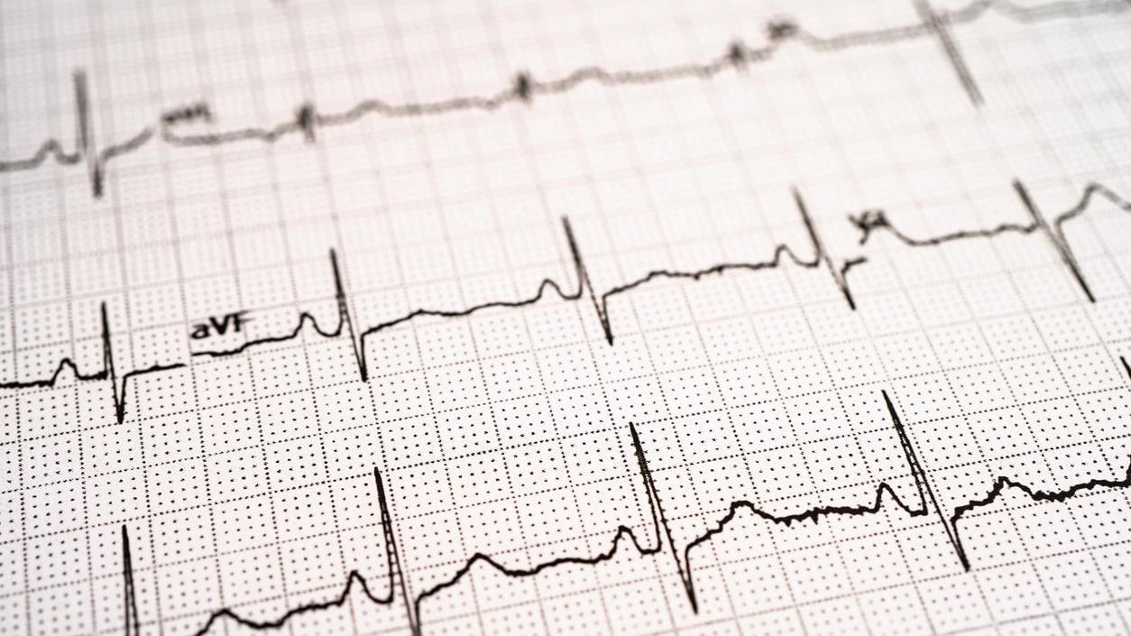EKG Nedir, Ne Zaman ve Neden Çekilir?