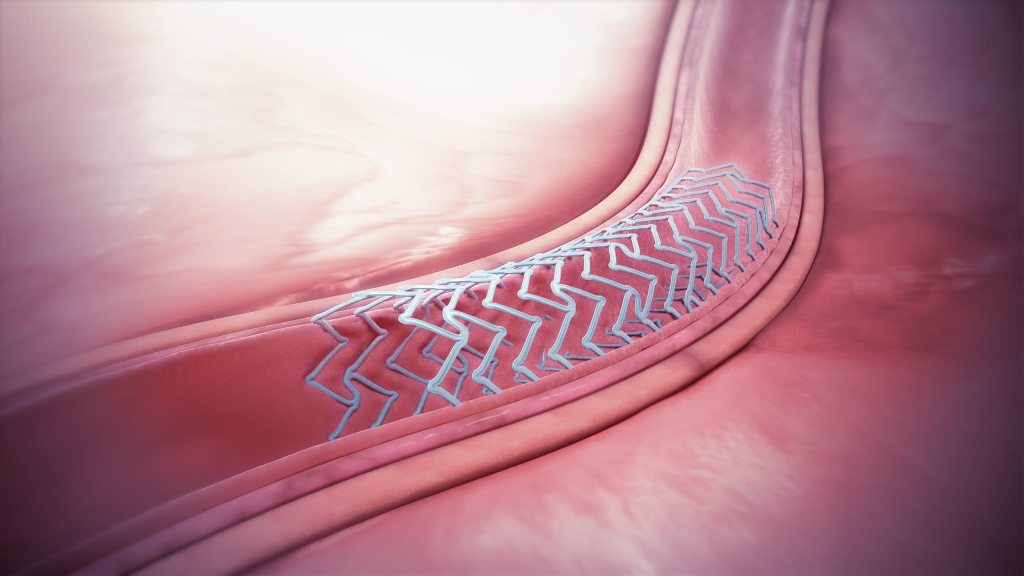 Stent Sonrası Günlük Yaşam