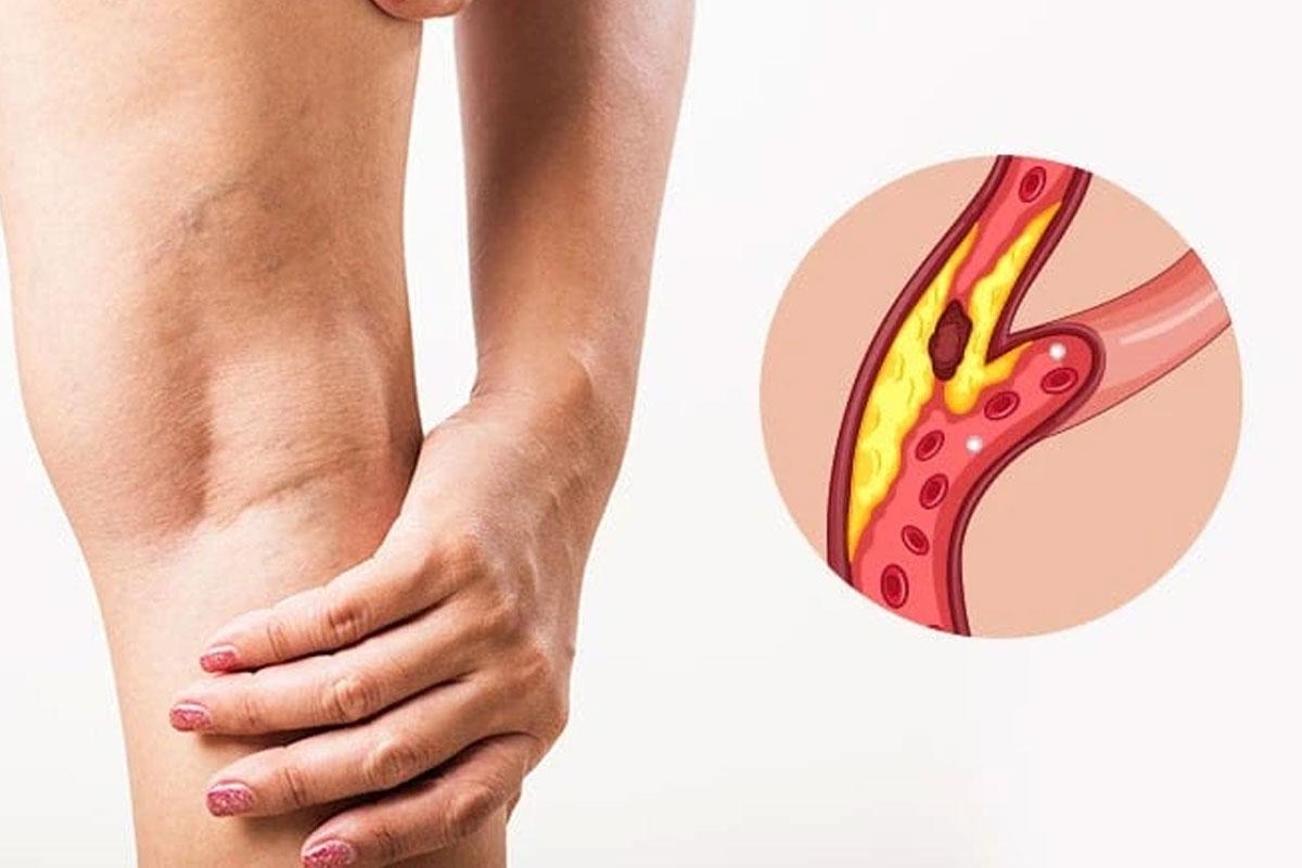 Damar Darlıkları ve Tıkanıklıkları — bilgilendirme görseli