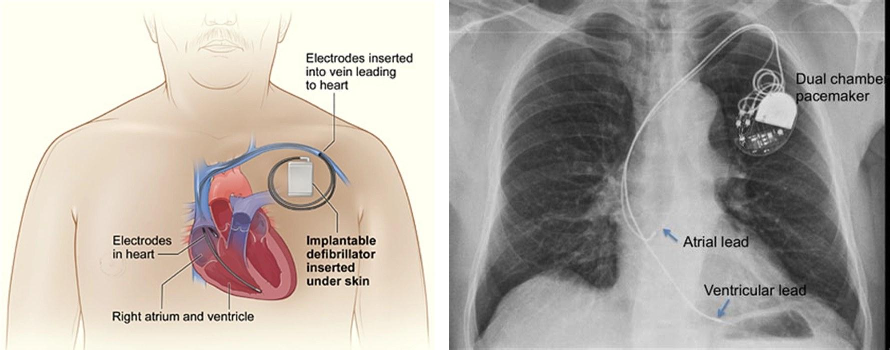 Kalp Pili (Pacemaker)