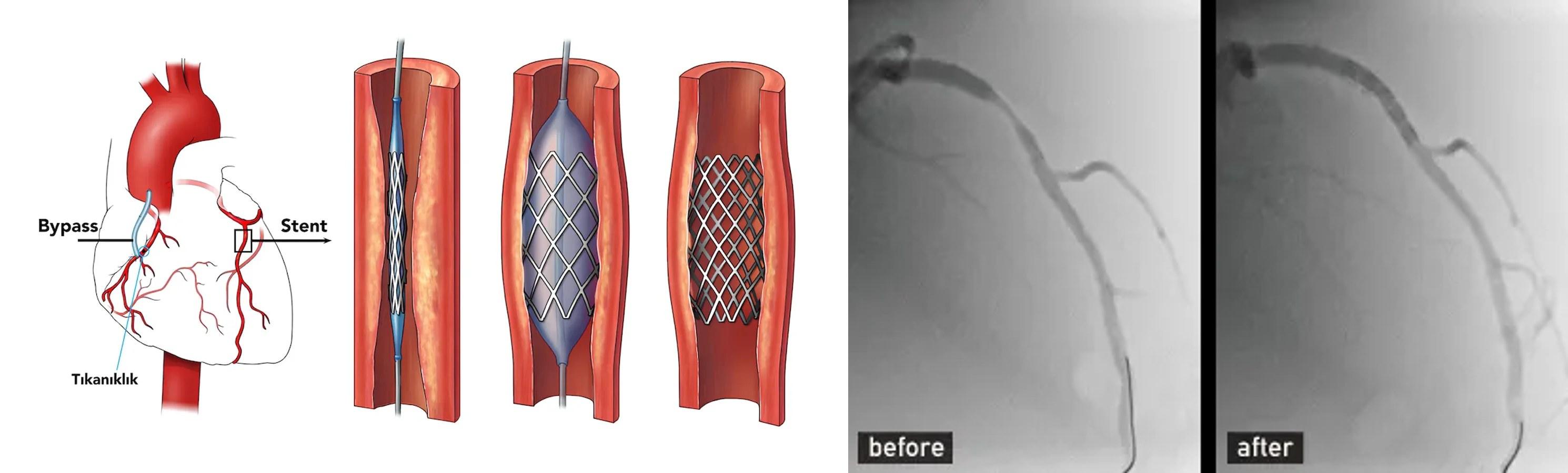 Koroner Stent Uygulamaları işlemi