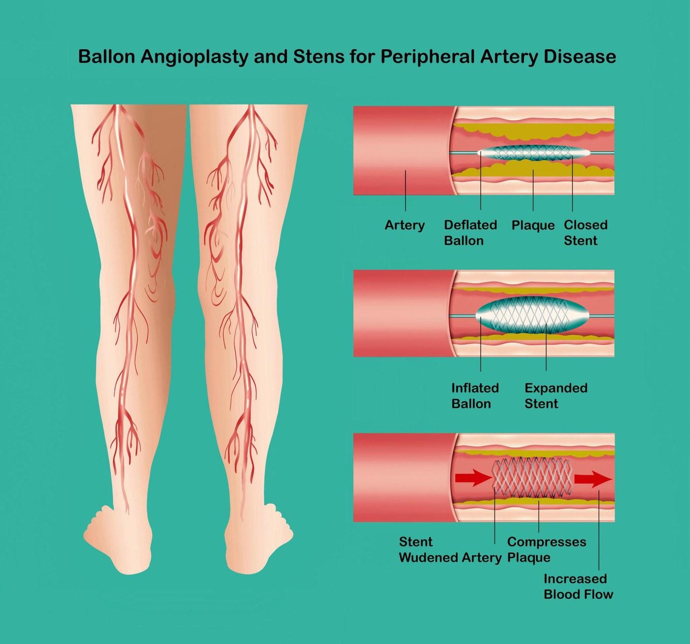Peripheral Angioplasty and Stent — informational image